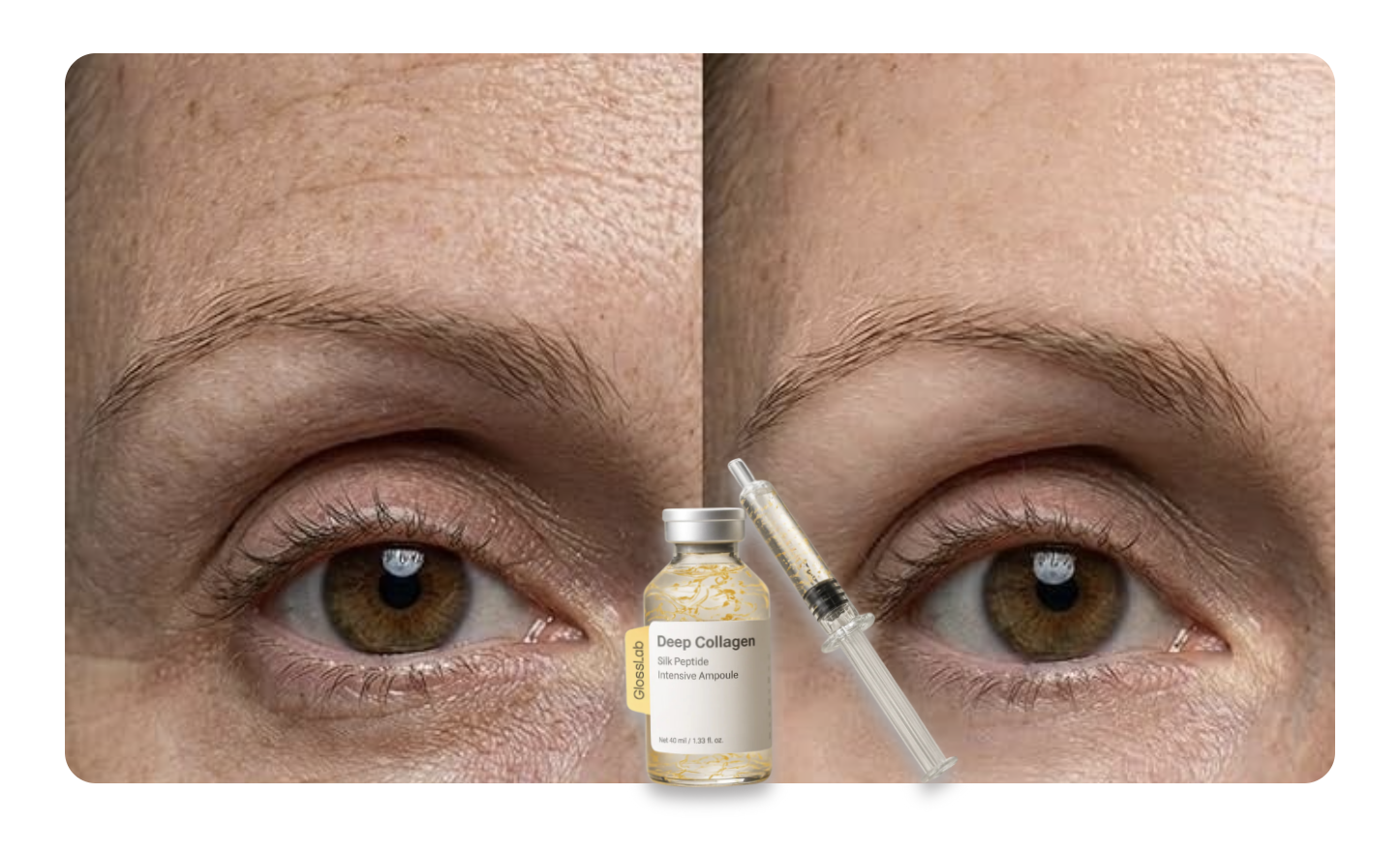 Resultado real — antes e depois do Silk Peptídeo da Seda, redução de linhas e firmeza